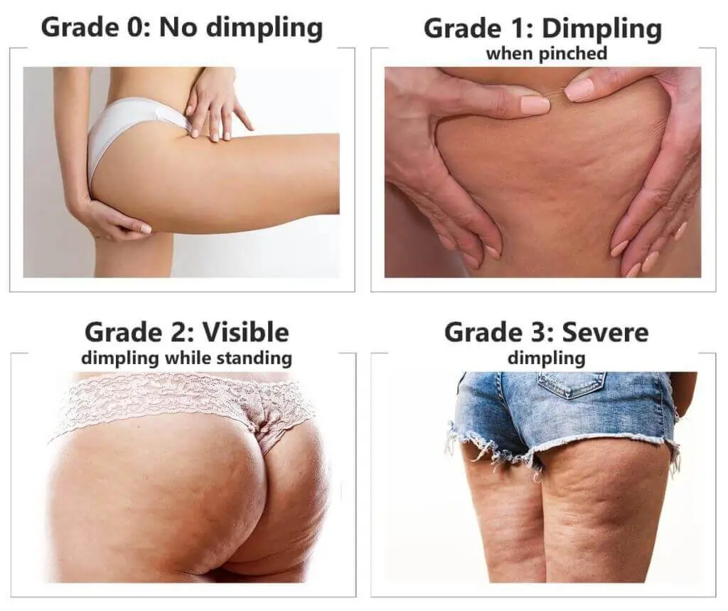 Representation of the stages of cellulite development Shepperton Green