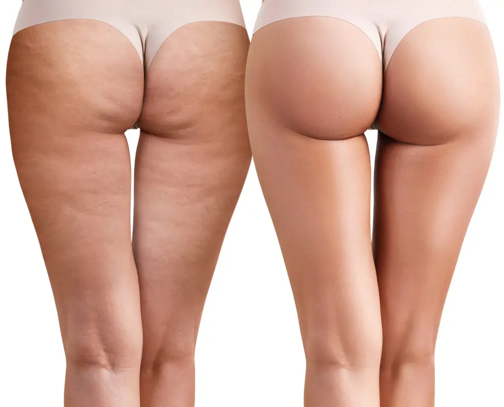 Read about cellulite Shepperton Green: causes, treatments, and debunked myths